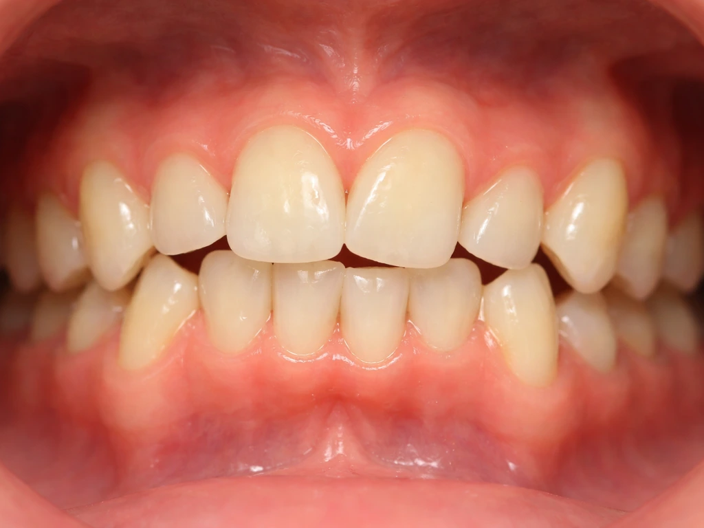 Why Do Teeth Grow Crooked and How to Fix It