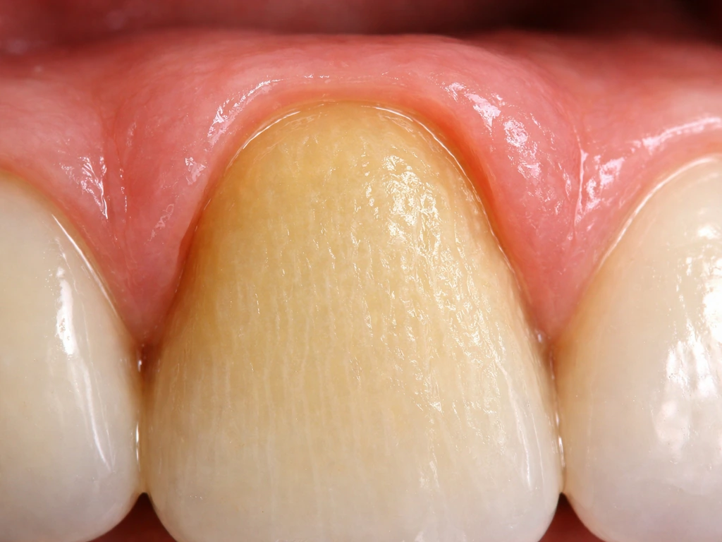 Close-up photo showing a single tooth with exposed root from true gum recession