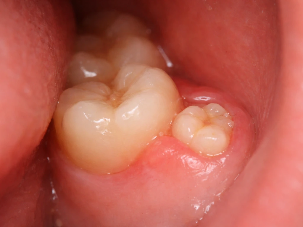 How to Make Wisdom Teeth Erupt Faster: Reality and Next Steps